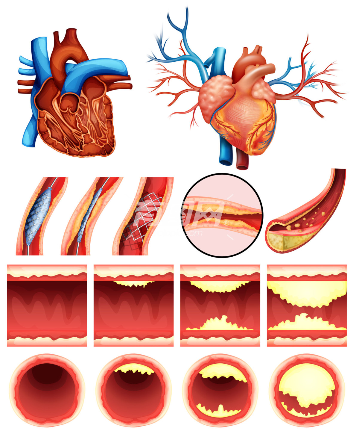 医疗健康科普 心脏血栓形成和疏通插画