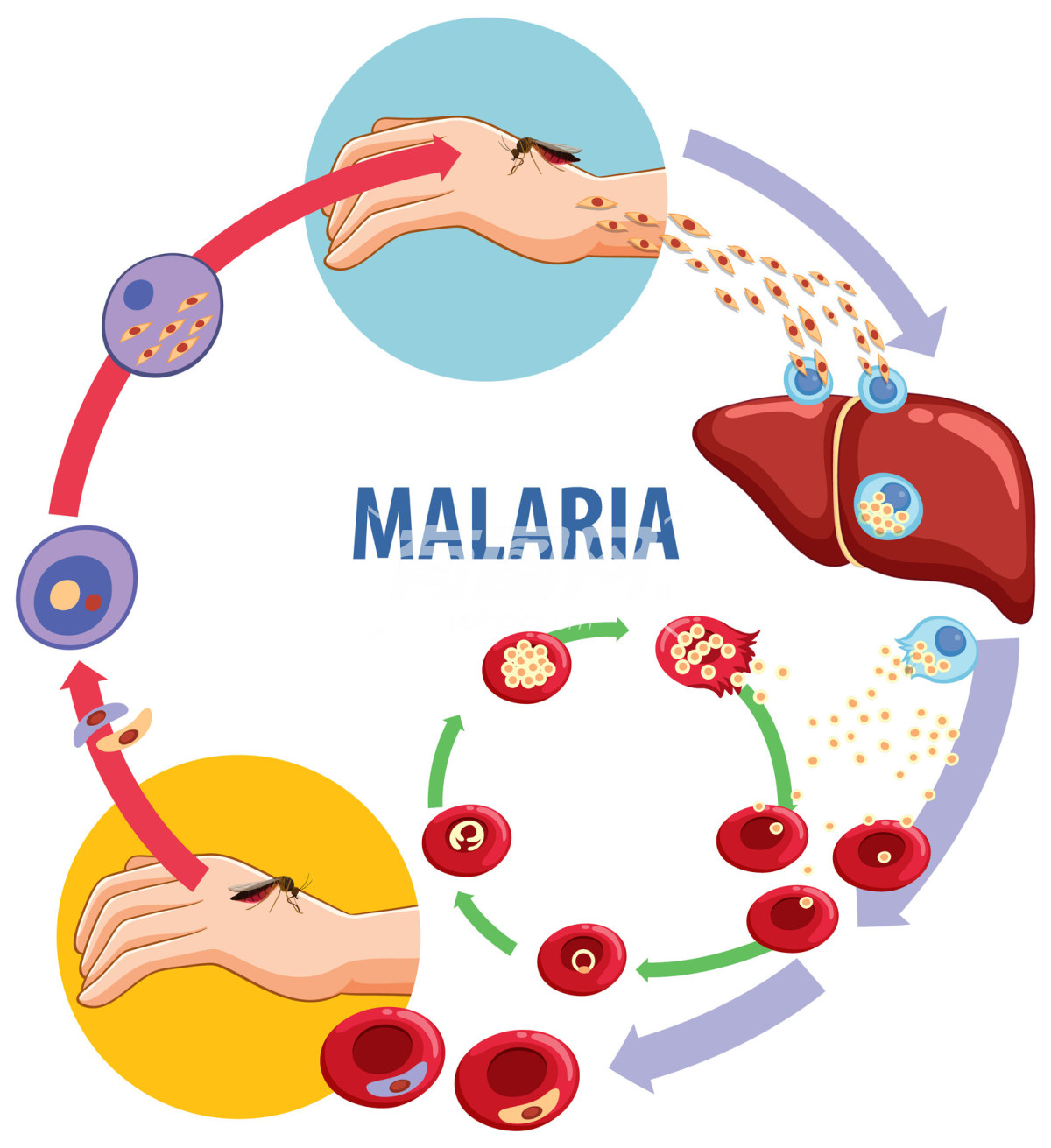 医疗健康科普 疟疾形成过程插画