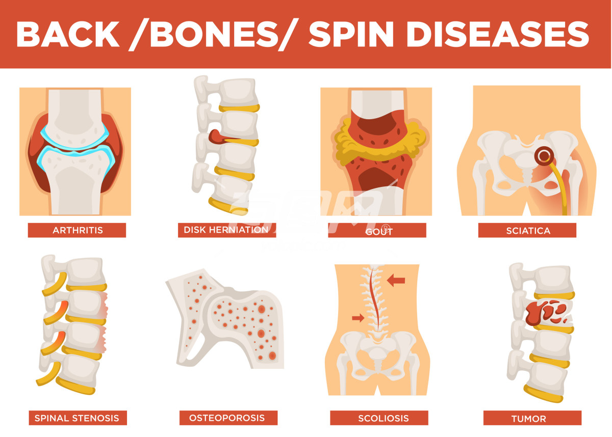背部骨骼疾病信息图
