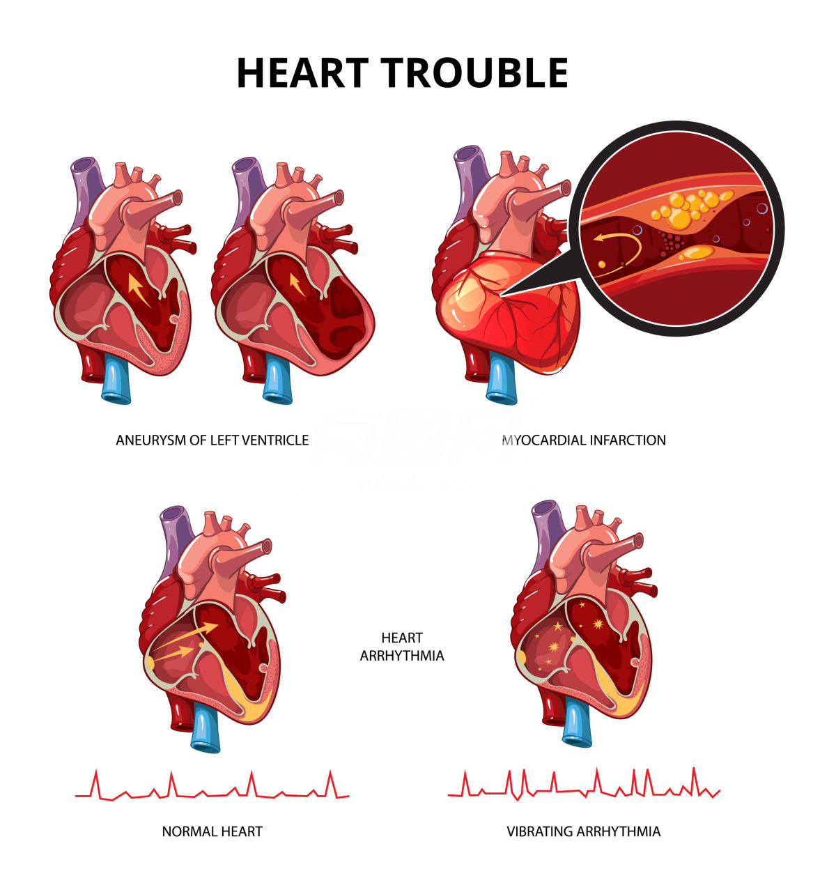 心脏医学信息图