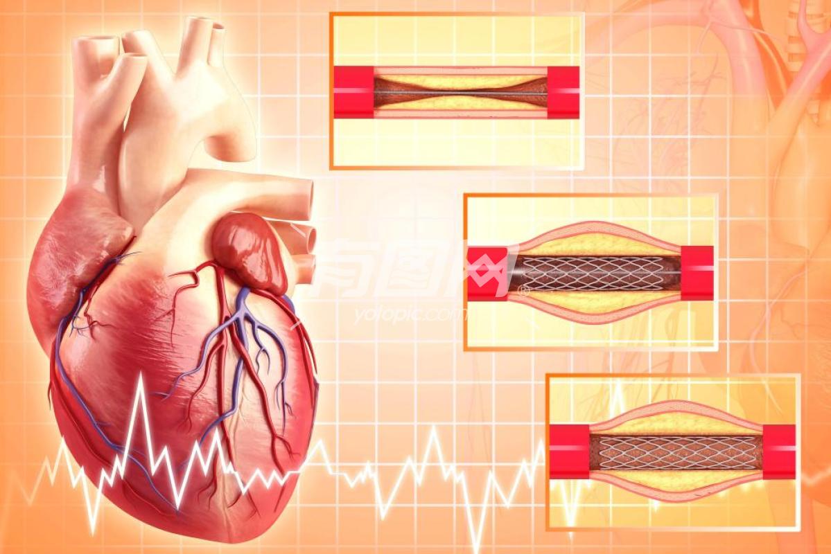 心脏冠状动脉支架