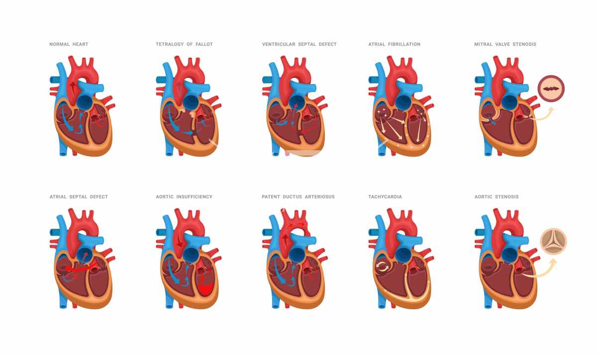 心脏解剖结构及相关疾病图示
